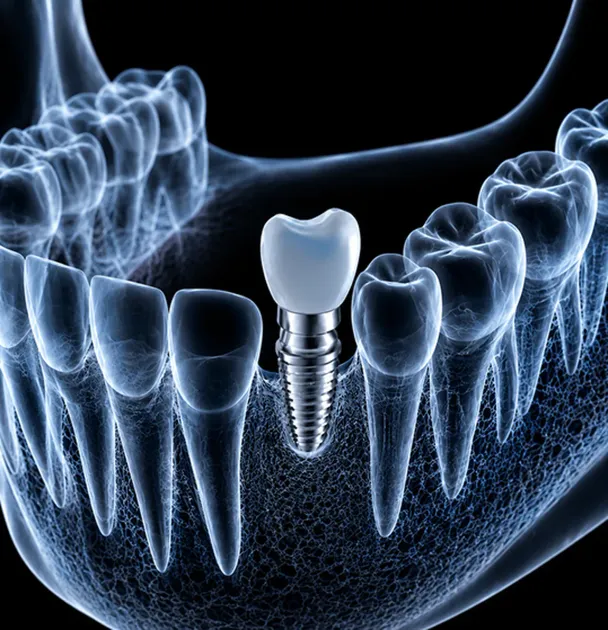 Impianto dentale con corona inserito nella mandibola visualizzata in trasparenza